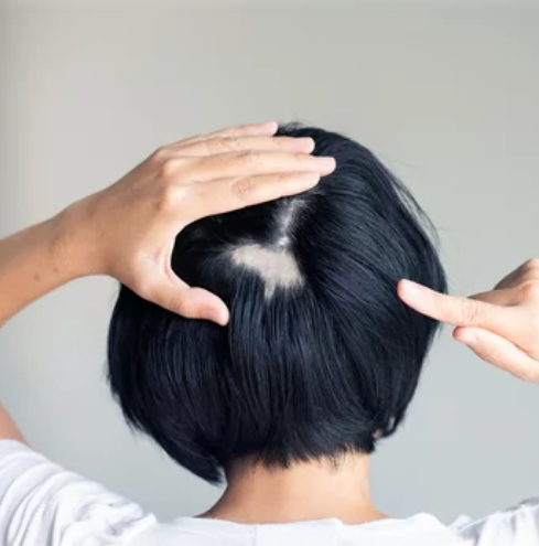 Alopecia Areata