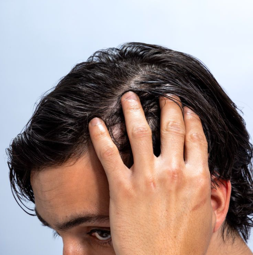 Minoxidil or Finasteride