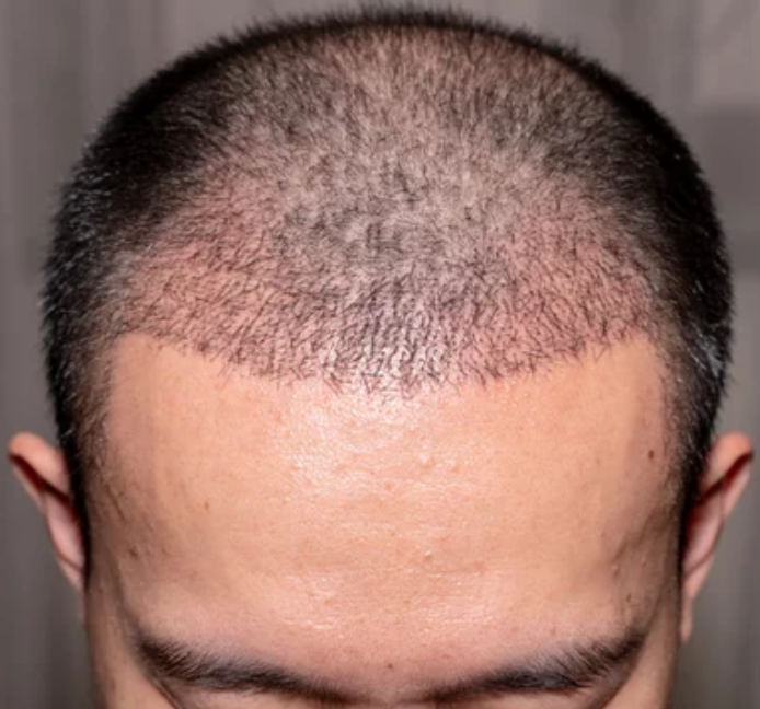 Post-Hair-Transplant Scalp Care