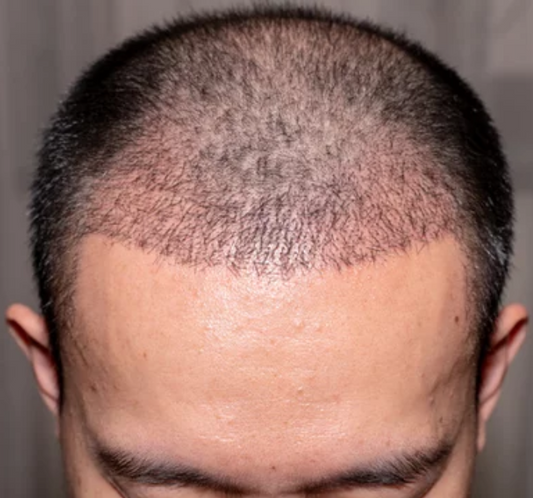 Post-Hair-Transplant Scalp Care