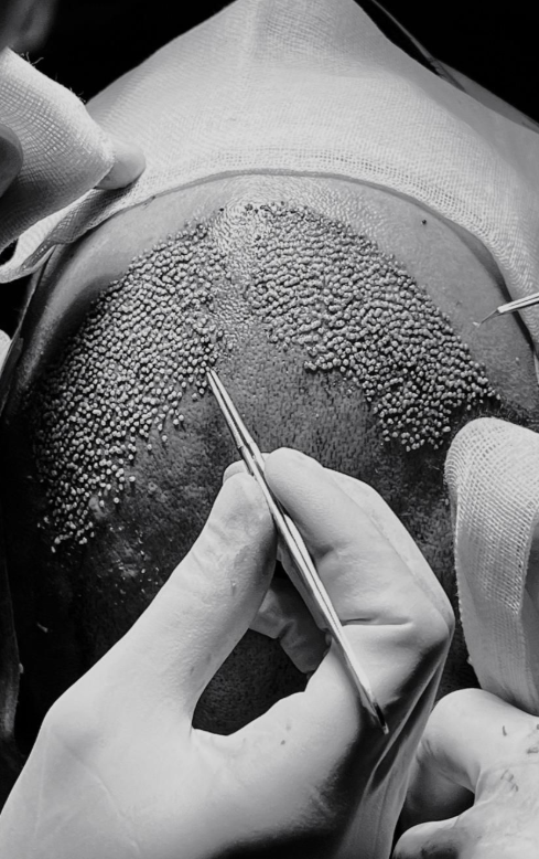 The Modular Advantage: How the Pro Exo Series Transforms Post Hair Transplant Recovery in Clinics